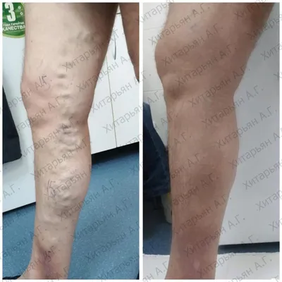 Варикоз на ногах - новая статья от Клиники в Уручье
