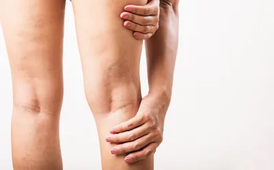 Удаление вен на ногах - как это делают? | Beauty Insider