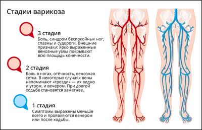 Компрессионное белье при варикозе ног: для чего нужно, помогает ли, как  выбрать и правильно носить для женщин и мужчин | АО «Тонус»