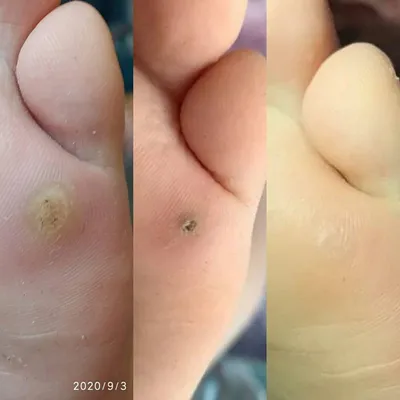Story of wart removal 🌸 Dynamics from SEVERAL SESSIONS 🌸 Pedicure with  preparations 🌸 Eng. SUBTITLES - YouTube