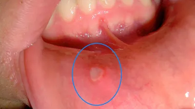 Стоматит у взрослых: лечение, причины, симптомы
