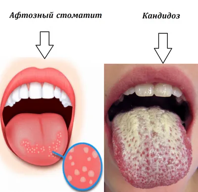 Афтозный стоматит: причины, симптомы, диагностика и лечение хронического  стоматита у стоматолога