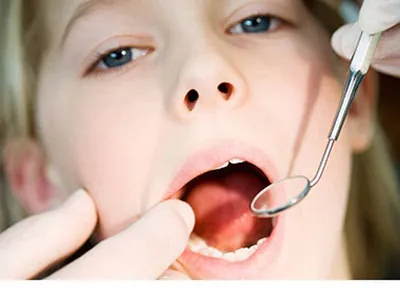Молочница во рту (кандидоз) – у детей и взрослых, симптомы, причины, лечение
