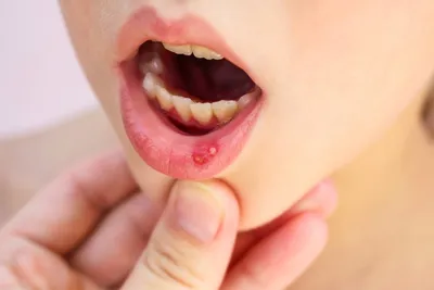 Лечение стоматита у детей: симптомы, классификация, профилактика | Цены на  стоматологические услуги в клинике Церекон в Москве