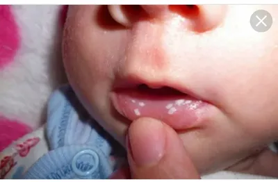 Язвочки и ранки во рту у ребенка: белые и красные болячки и язвы на губах,  небе и десне, чем лечить высыпания и гнойники у детей