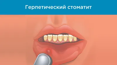 Стоматит! Откуда он берётся? | Беглова Алия | Дзен