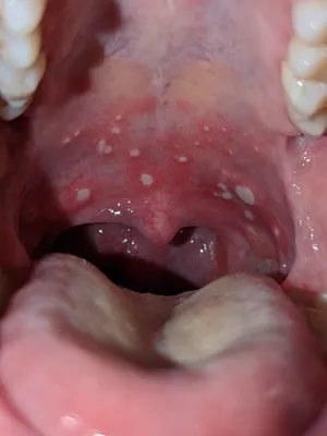 Кардидоз полости рта - симптомы и лечение у взрослых и детей