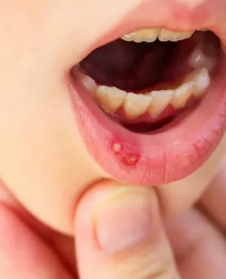 Стоматит полости рта, причины, типы стоматитов – Профилактика, лечение, фото