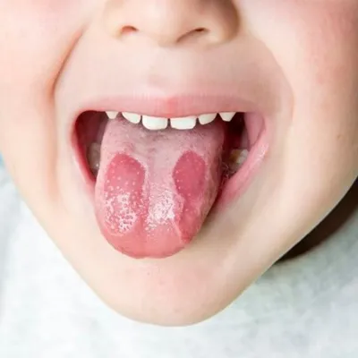 Молочница во рту (кандидоз) – у детей и взрослых, симптомы, причины, лечение