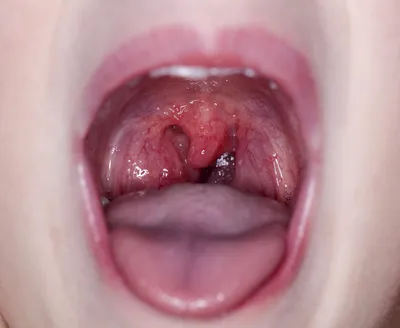 Болит верхнее небо - Вопрос стоматологу - 03 Онлайн