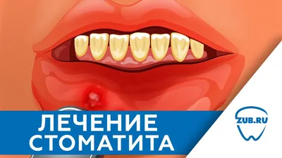 Как и чем лечить стоматит во рту у ребенка и взрослого: симптомы, причины  постоянного появления, первые признаки возникновения, эффективное лечение и  лекарства