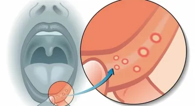 Язвочки на верхнем небе: причины, симптомы, лечение и профилактика