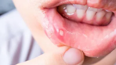 Перикоронит зуба мудрости: симптомы заболевания, лечение воспаления  капюшона десны, удаление