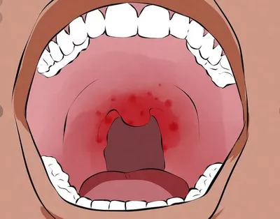 Что такое кандидоз полости рта? | parodontax