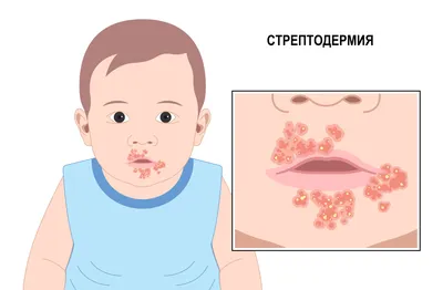 Стрептококковая инфекция - причины появления, симптомы заболевания,  диагностика и способы лечения