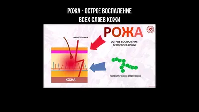 Стрептококковая инфекция - симптомы, лечение, диагностика