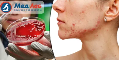 Пиодермия: причины, симптомы, диагностика и лечение пиодермии в Москве -  сеть клиник «Ниармедик»