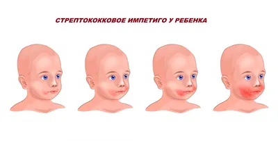 ДЕРМАТОЛОГ Online ПОДБОР УХОДА on Instagram: \"✓СТРЕПТОДЕРМИЯ -это  бактериальное заболевание,которое чаще встречается у детей,но может  возникать и у взрослых. Возбудети стафилококки и стрептококки. 🤝Заражение  происходит контактным путём,через предметы ...