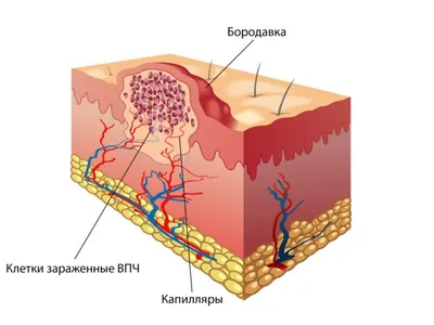 Строение бородавки фото фото