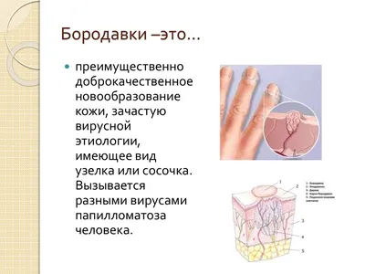 Бородавки на языке. Причины и лечение