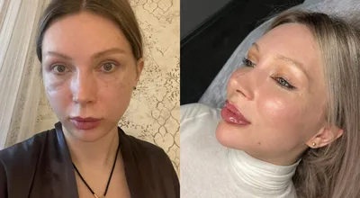 cosmetolog_ses_ - 💧Малярные мешки под глазами(суфы )... | Facebook