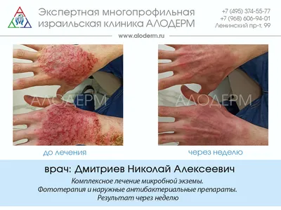 Экзема на руках и ногах: лечение в СПб в клинике МедПросвет | Клиника  МедПросвет