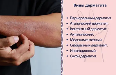 Экзема - причины, симптомы и лечение | Описание заболевания - meds.ru