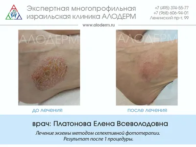 Обострение экземы у взрослых: причины, симптомы, рекомендации по уходу |  Pharmacosmetica.ru | Дзен