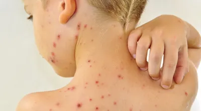 Как избавиться от шелушения кожи на коленях