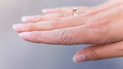 Борьба с сухостью кожи рук - эффективные препараты против сухости рук.