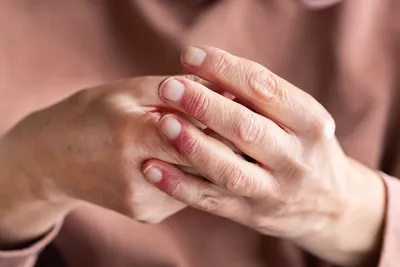Сухой дерматит на коже ‒ причины и лечение