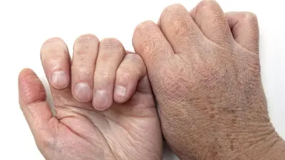 Экзема: причины, чем лечить и мазать, как выглядит экзема на руках, ногах,  лице и пальцах