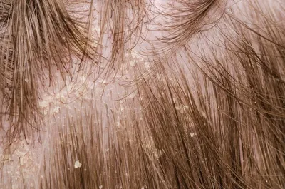 Шелушение кожи головы – лечение в клинике IHC | Почему шелушится кожа головы ?