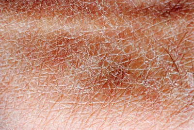 Сухая кожа - чего не хватает в организме: причины и препараты для лечения