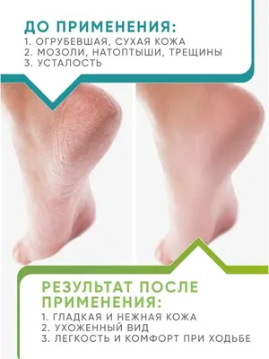 Обработка сухой кожи ног - кабинет подолога в Донецке
