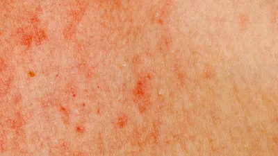 Круглое шероховатое сухое пятно на коже ребенка - Вопрос дерматологу - 03  Онлайн
