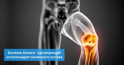 Виктори Клиник on Instagram: \"🏃Рентген коленного сустава – метод  диагностики в травматологии и ортопедии, который назначается пациентам,  обратившимся с жалобами на боли в колене. Рентгенография информативна для  оценки плотных тканей сустава. Это