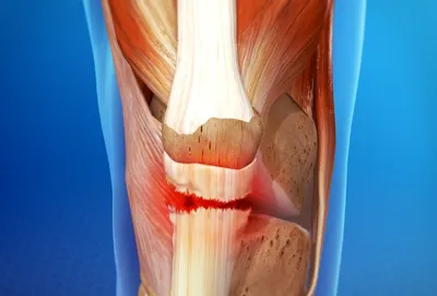Причины возникновения деформаций коленного сустава и их лечение