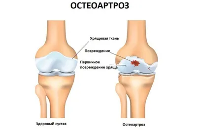 Суставная мышь в правом колене... - Форум \"Спортивная медицина\"