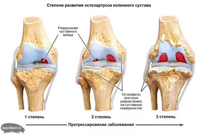 Синовит коленного сустава: причины, симптомы и лечение