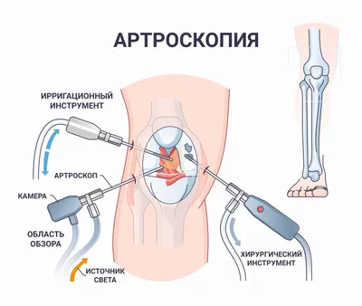 Артроз коленного сустава (гонартроз) - симптомы, степени и лечение