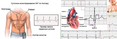 Суточное мониторирование ЭКГ по Холтеру