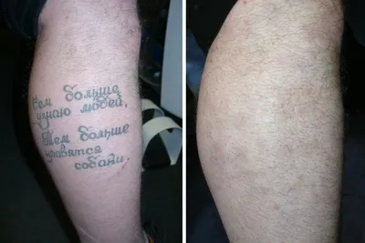🚩\"MALEVICH\" | Лазерное Удаление Татуировок В Новосибирске