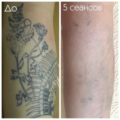 Удаление тату Челябинск | Black Moon Tattoo