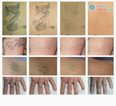Татуировки удаляет не лазер! Блог о лазерном удалении | Пикабу