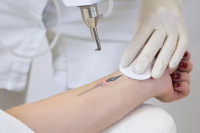 Удаление татуировок пикосекундным лазером в Москве - цены, запись на прием  | Клиника лазерной косметологии Candela