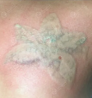 Лазерное удаление татуировки в Казани