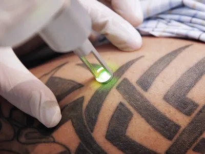 Удаление (сведение) татуировок, татуажа на пикосекундном лазере Candela |  Интернет-журнал Estetmedicina.ru