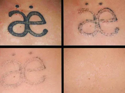Лазерное удаление татуировок в Пятигорске: цена, отзывы, фото — «ЕКК»