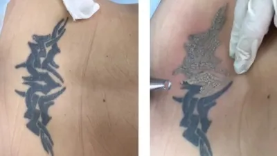 Удаление татуировок лазером в Москве | Сведение татуажа